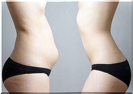 A body before and after cryolipolysis.