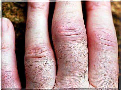 Some tips for treating rheumatoid arthritis.