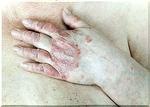 natural psoriasis treatment