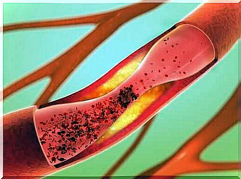 A damaged blood vessel in vascular dementia