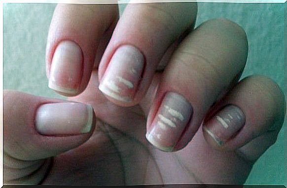 White marks on the nails.