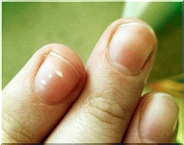 Treatment of white marks on the nails.